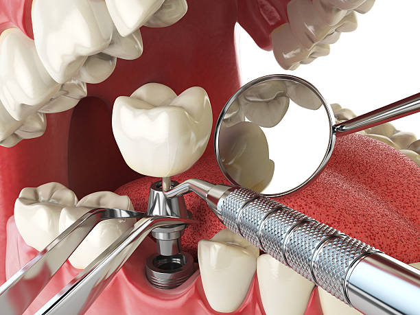Emergency Dental Filling Replacement in OH